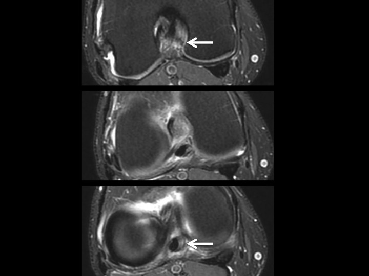 Figure 4 for case posteromedial bundle of posterior cruciate ligament ( RID2786 )